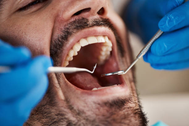 Best Chipped Tooth Repair Near Me  in Lake Tansi, TN